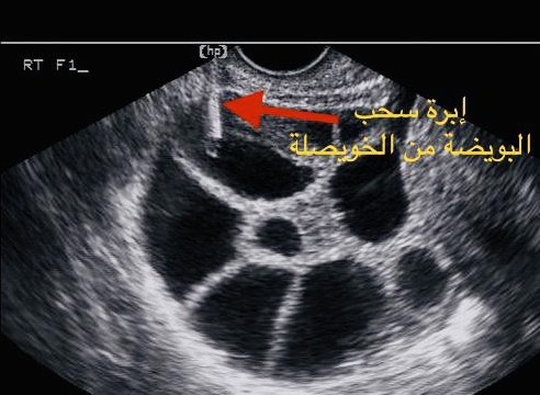 هناك فرق بين الحويصلات التي نراها بالسونار وبين البويضات التي نستخرجها من مختبر الحقن المجهري