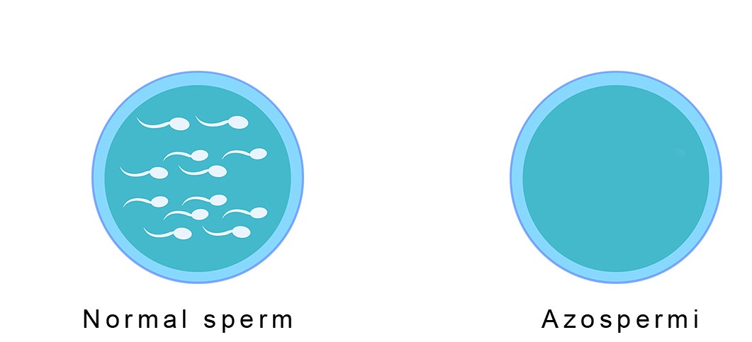 ازوسبيرما Azoospermia