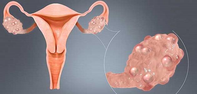 علامات تدل على وجود تكيس مبايض