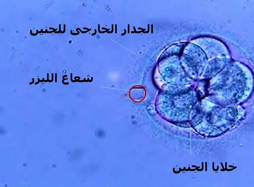 عمليات ثقب جدار الاجنة ؟