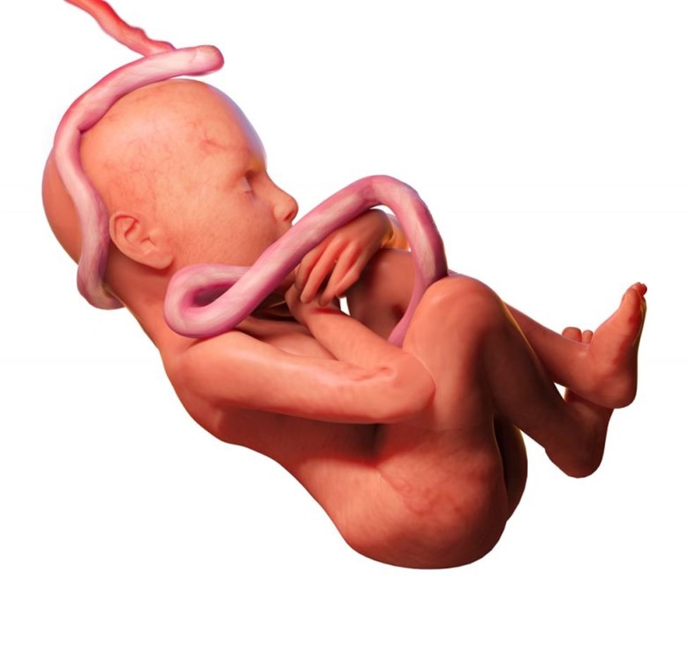 الحبل السري وخطورة التفافه حول رقبة الجنين أثناء الحمل أو عند الولادة